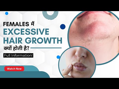 महिलाओं में चेहरे पर अनचाहे बाल क्यों आते है? | जाने इसके इलाज | Excessive Hair Growth in Female