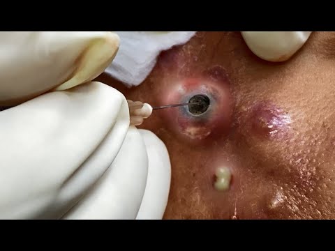 Popping huge blackheads and Pimple Popping - Best Pimple Popping Videos