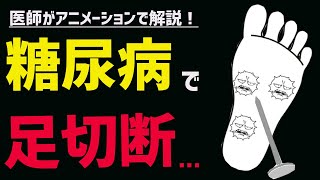 知らないと後悔する糖尿病と足の3つの症状