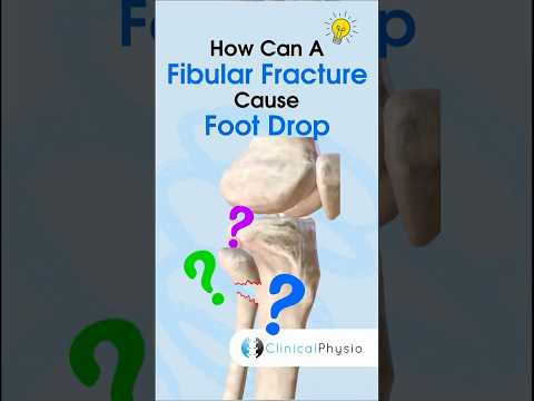 Foot Drop Causes #physicaltherapy #physiotherapy #footdrop #anatomy #fibula #fibulafracture