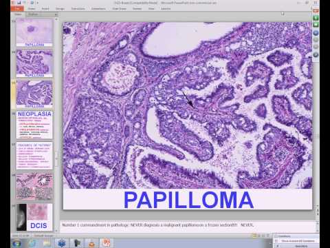 Medical School Pathology, 2013 Season, Session #25: Female Reproductive III and Lab