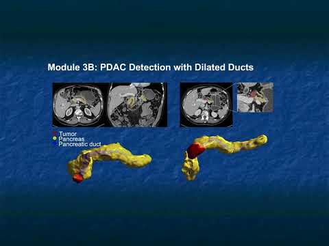 The Role of AI in the Detection and Management of Pancreatic Cancer - Part 2