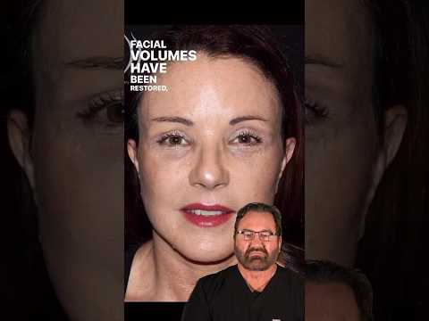 AMAZING Facelift Results - Surgeon Reacts