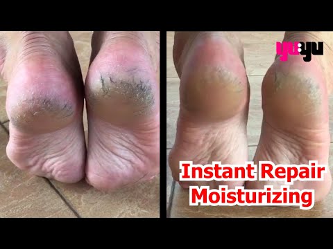 😱 Instant Repair Cracked Foot & Dry Skin 😱 | Aloins Eaude Cream | YuYu Collection