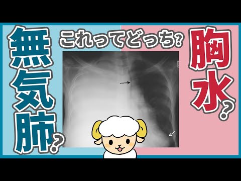 レントゲンで片方真っ白な時、無気肺と胸水の見分け方