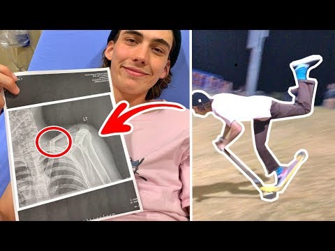 HOW TO NOT HANGFIVE ON SCOOTER (Broken Collarbone)