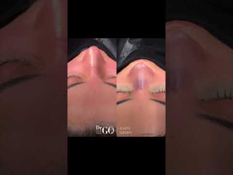 Patient Journey: Rhinoplasty Transformation 🌟