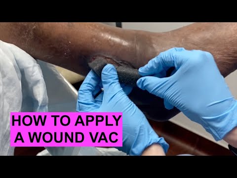 WOUND VAC Explanation & Tutorial!