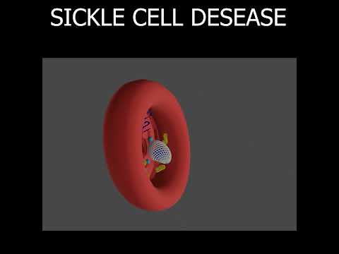 SICKLE CELL DESEASE EXPLAINED