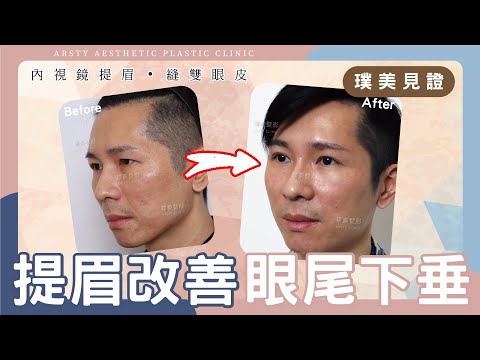 【內視鏡提眉、縫雙眼皮】改善眼尾下垂～變身型男業務！| 璞美整形外科醫美診所