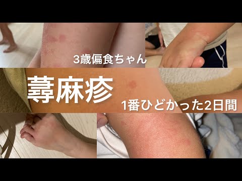 【慢性蕁麻疹】3歳　体力低下改善　漢方を飲む。