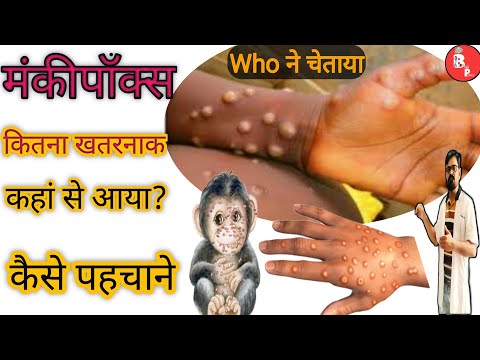 #Monkeypox/#मंकीपॉक्स लक्षण और बचाव/#healthcare /WHO ने ग्लोबल इमरजेंसी घोषित किया