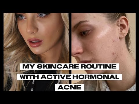 Haley In Sweden Vlog #3 | Skincare Routine | Hormonal Acne | How I Maintain My Skin With Active Acne