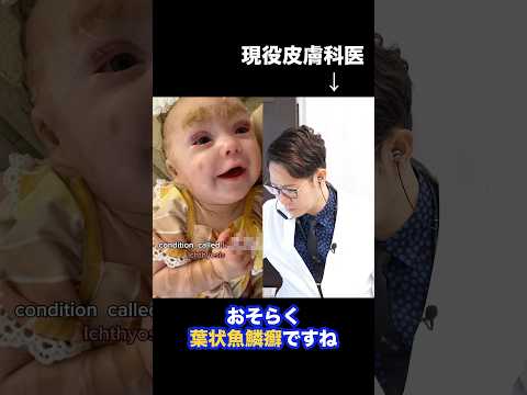 Explanation of Lamellar Ichthyosis by a Japanese Dermatologist