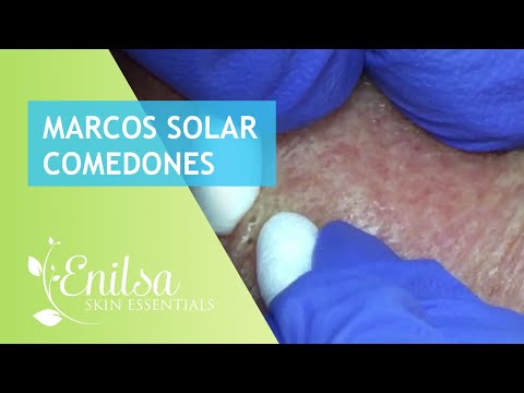 Marcos Solar Comedones Extractions