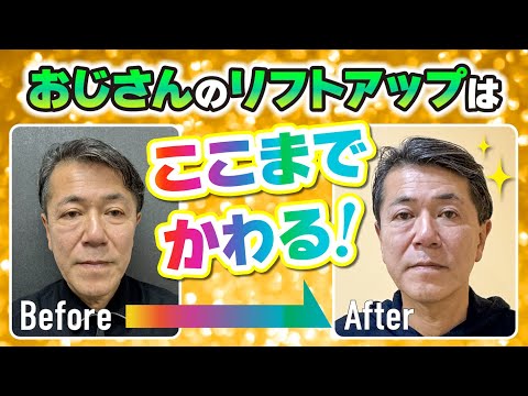 医師が自身の体を使って証明！桑満医師の若返り計画！おじさんのリフトアップはここまでかわる！ #リフトアップ #整形  #おじさん整形