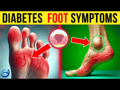 11 SCARY Signs of Diabetes Your Feet Might Be Showing | Most Are Guilty of #3