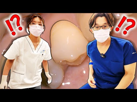 むし歯を見落とす⁉　※動画の詳細はコメント欄　#VPT　#VitalPulpTherapy　#MTA　#部分断髄法