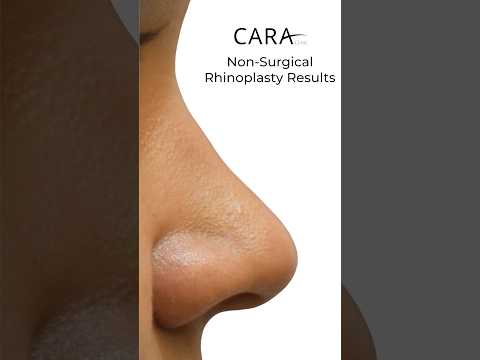 Non Surgical Nose Job Results | Before and After