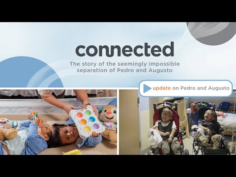 update on Pedro and Augusto, separated conjoined twins from connected documentary