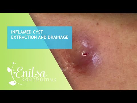 Inflamed Cyst Extraction and Drainage