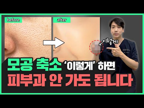 의학적으로 가장 확실한 모공 줄이는 방법 | 아기모공 만들기! 집에서도 충분해요~