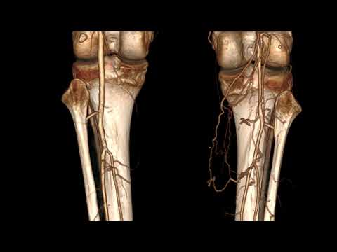 Segmental popliteal artery occlusion with rich collateral network