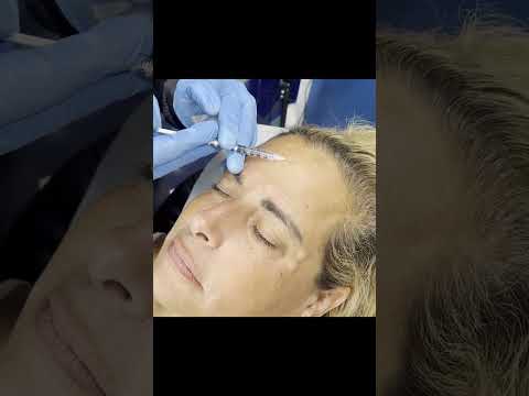 Xeomin Injections For Frown Lines, Forehead Lines & Crows Feet, Botox Services at Plantation Med Spa