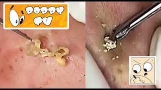 Large Closed Comedones - Whiteheads Extraction