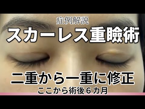 二重修正の症例解説。スカーレス重瞼術で二重瞼から一重瞼に。術後６か月