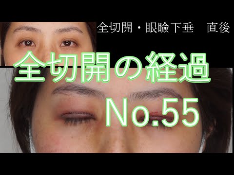 全切開+眼瞼下垂　55