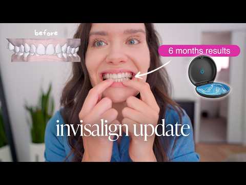 the reality of invisalign: is it really worth it? 🤫 my invisalign experience (part 4)