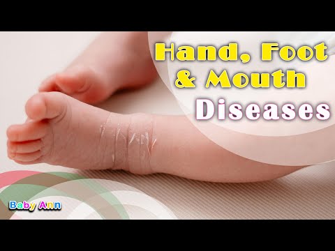 Hand, Foot and Mouth Disease | Treatment of Hand, Foot & Mouth Disease| Treatment and When to Worry?