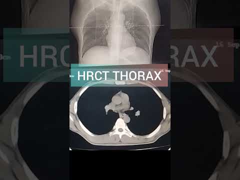 HRCT Show Solitary Nodule