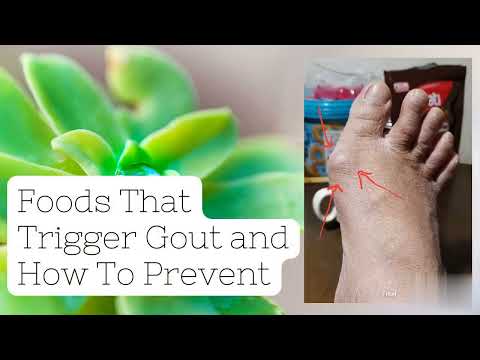 What are the trigger of Gout and how to prevent it for men and woman...urgent!!!