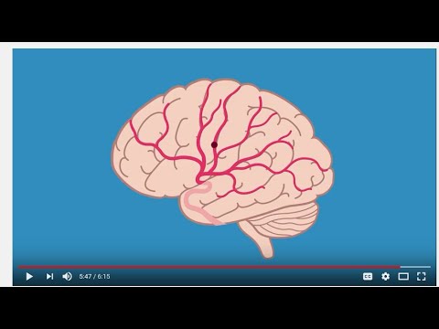 Introdução ao AVC-Introduction to Stroke (Portuguese)