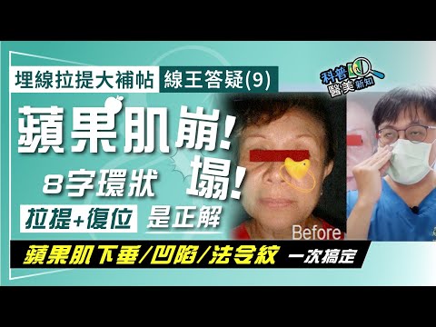 埋線拉提大補帖｜線王答疑(9)「蘋果肌拉提+復位」8字環狀深層拉提  中臉老化難題一次搞定！　蘋果肌"挺起來" 同步改善眼下凹陷/消滅法令紋 科普醫美新知366-20241101