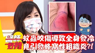 蚊蟲咬傷導致全身發冷，竟引發蜂窩性組織炎？！【#醫師好辣】20210804 part3 EP1177 鄭丞傑 舒子晨