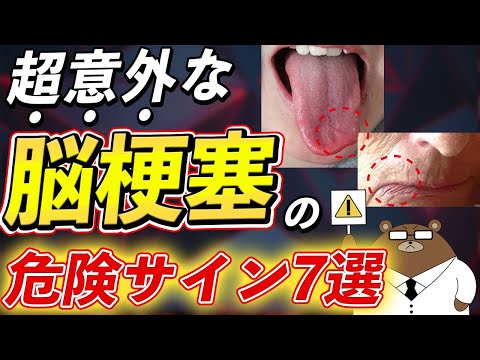 放置厳禁！絶対に見逃さないで！知らないと後悔する脳梗塞の危険な7つの症状とは？