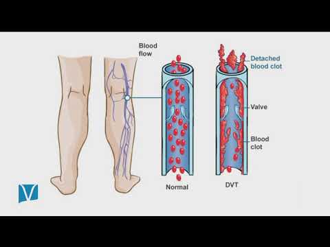 DVT Awareness Month: Interview with Dr Gilster on AMNorthwest