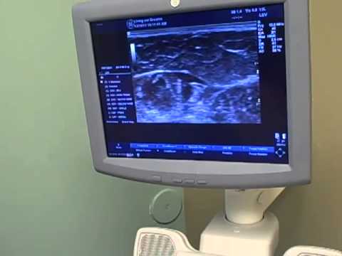 Varicose Vein Treatment Radiofrequency Ablation Venefit Center for Venous Disease Gilbert AZ