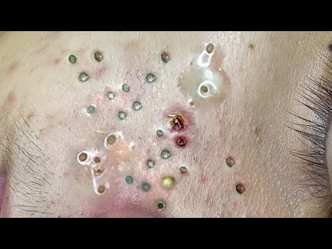 Soothing Blackhead Removal #shorts