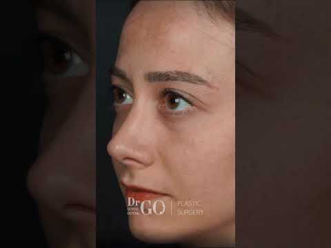 Rhinoplasty Transformation by Assoc. Prof. Dr. Güncel Öztürk | Before & After Results