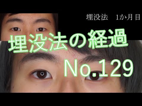 埋没法の経過　10代女性　ナチュラルな奥二重～末広へ