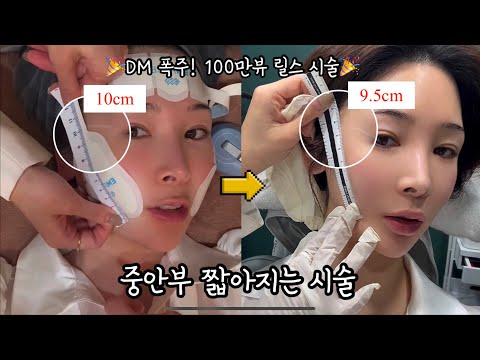 🔥엠페이스🔥중안부 짧아지는 시술 | 피부과 리프팅 비교&총정리|가격,유지기간 비교|유지 길게 가는 관리 꿀팁🍯