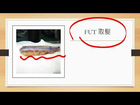 【衛教天地】FUT取髮-台中植髮林子鈞醫師教你的十二堂課-極緻美型·文心極緻皮膚科診所整形手術-林子鈞醫師：台中植髮_台中植眉_台中植鬍_台中掉髮_台中禿頭