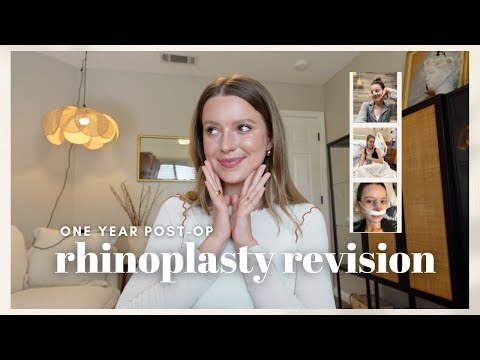 Rhinoplasty Revision Surgery: One-Year Post-Op Recap | Recovery, Healing, The Process + Tips