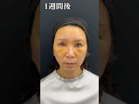 続編❗️地方在住60歳女性の全顔若返り整形☆術後1週間でこうなる☆ #眉下切開 #目上切開 #脂肪注入