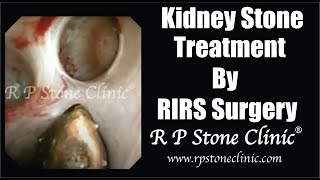 Video showing Kidney stone treatment by RIRS Surgery