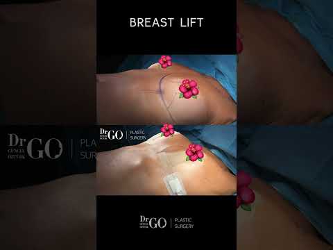 Before and After Breast Lift - Dr Guncel Ozturk #drgo #guncelozturk #breastlift